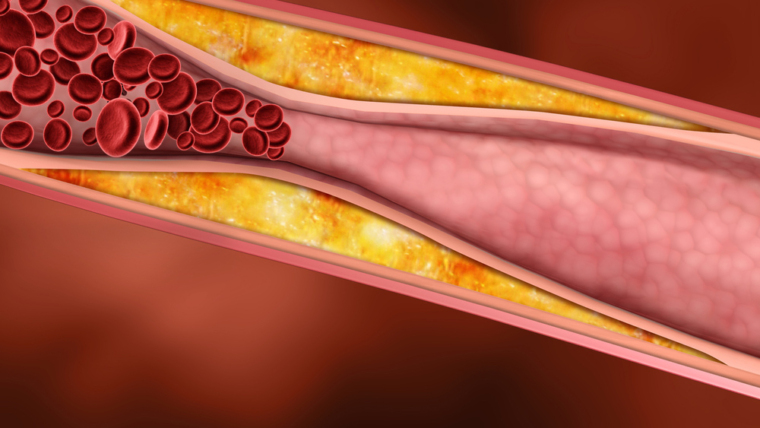 Understanding Triglycerides and Cholesterol