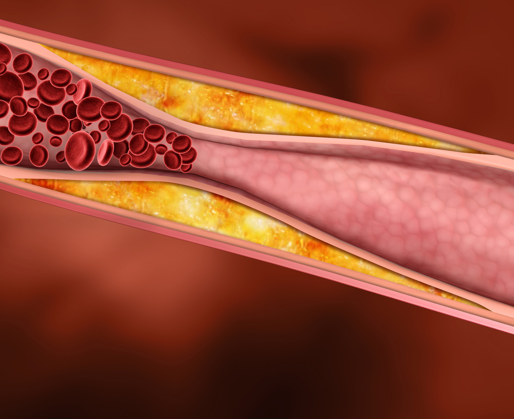 Understanding Triglycerides and Cholesterol